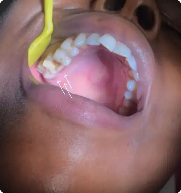 2. Close-up of a dental check-up showing molars and gums with arrows pointing to wisdom teeth.