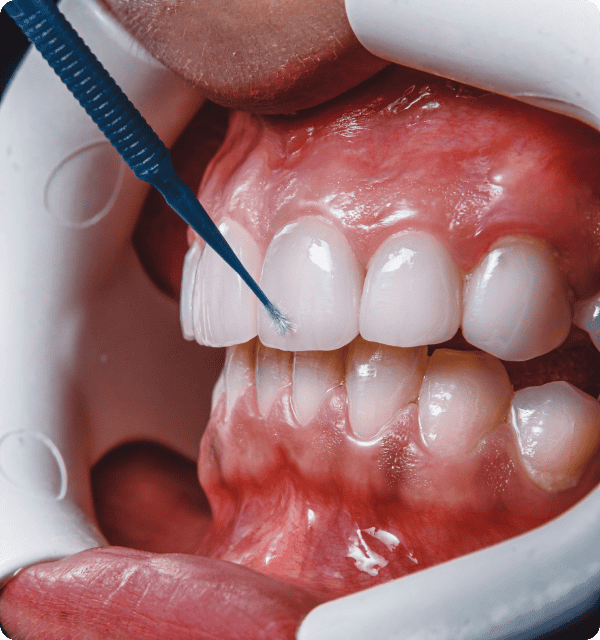 teeth whitening procedure