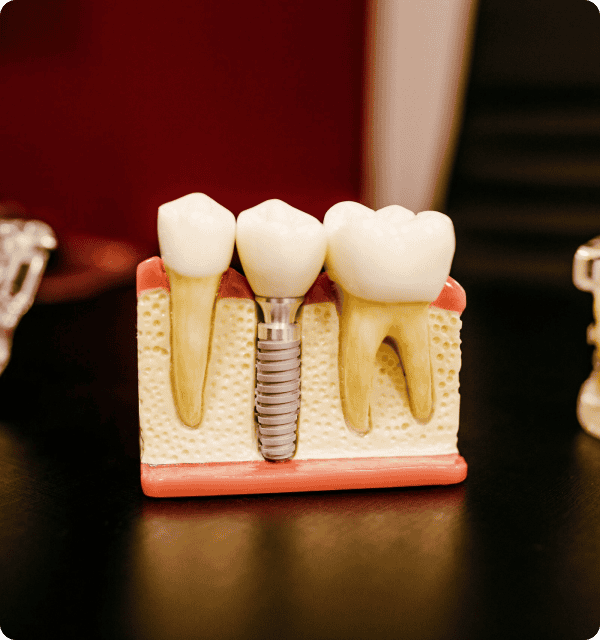 Dental implant model showing artificial tooth replacement for missing tooth restoration in South Africa.