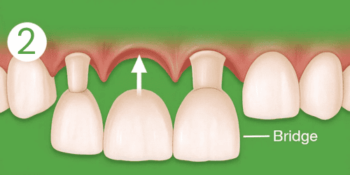Crowns and dental bridge placement for restored, functional teeth in South Africa.