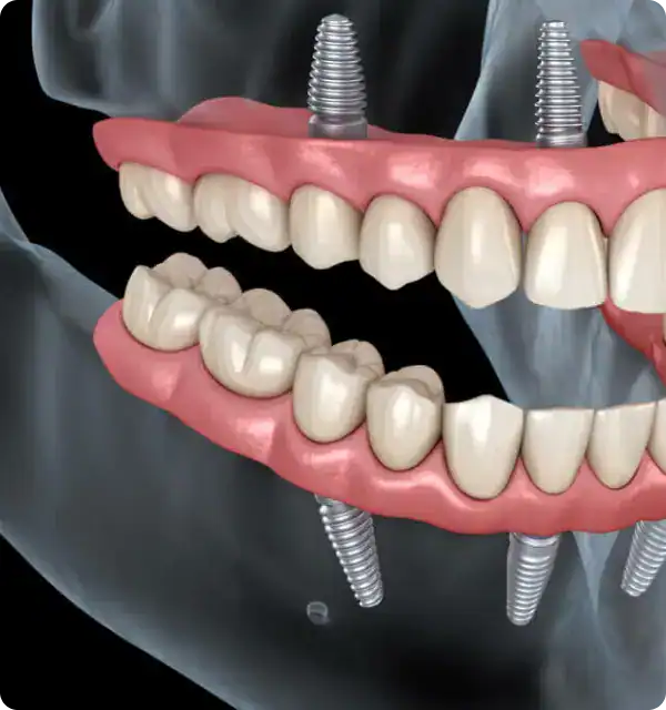 Dental implant dentures with screw-in prosthetics at DrSPateldentist clinic in South Africa.