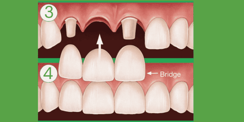 Gap closing dental procedure with dental bridge illustration.