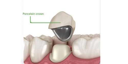 Ceramic Crown fused to metal