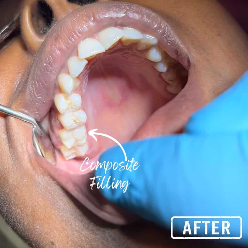 Dental composite filling on molar teeth for cavity restoration in South Africa.