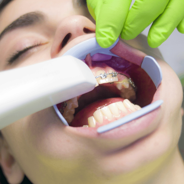 Braces installation