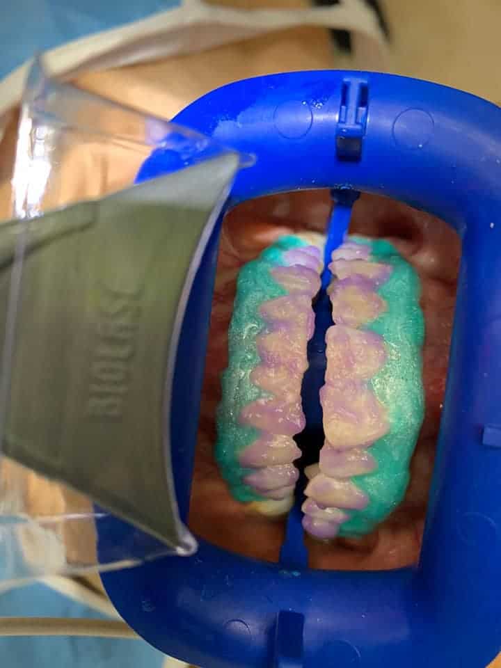 White dental models used for teeth whitening procedures in South Africa.