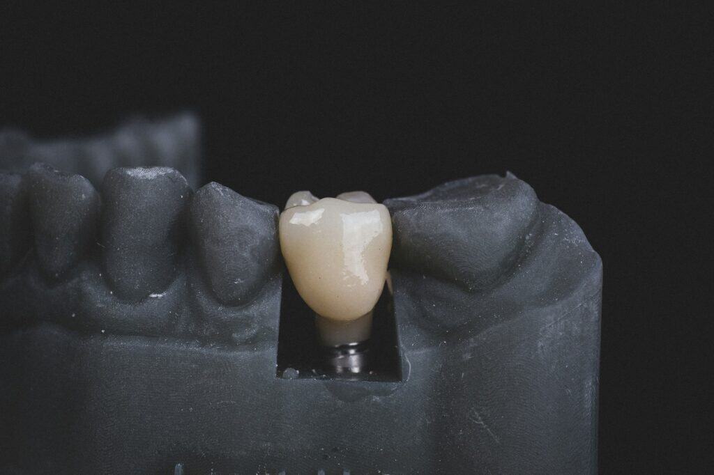 Dental implant