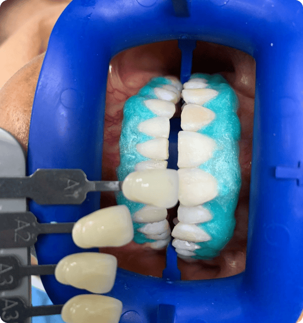 Composite dental shade matching with a shade guide in a dental clinic.