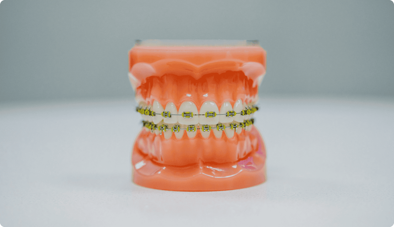 Clear orthodontic model with braces on a dental display, showcasing dental corrections and smile improvement.