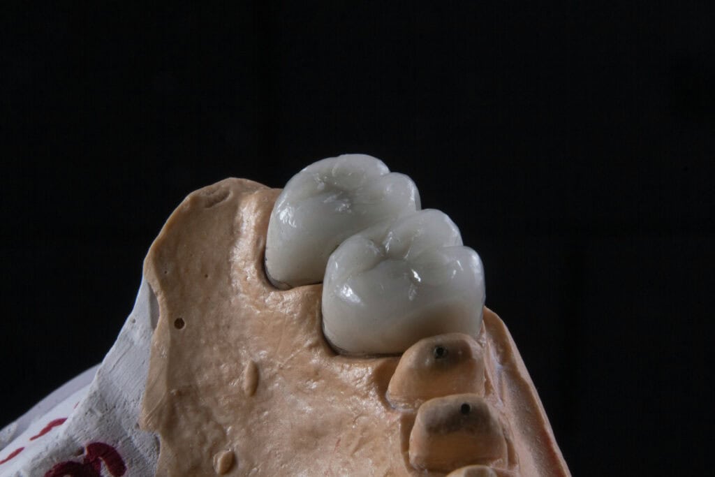 Porcelain dental crowns on a model for restorative dentistry in South Africa.